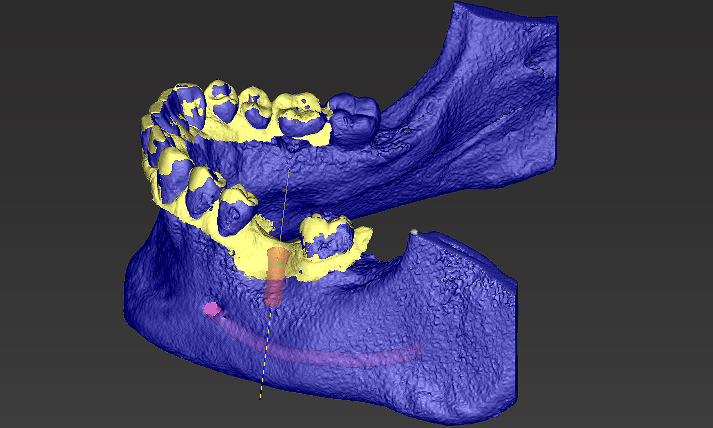 02 - Superpsootion de l'examen issu du CBAT et d'une empreinte optique intra orale en vue de la pose d'un implant en place de molaire.