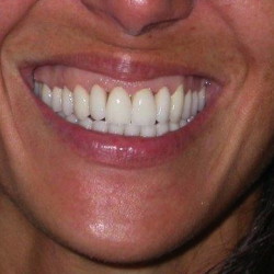 Dents alignées