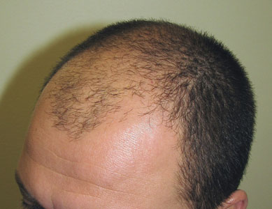 4a Man Before treatment-web