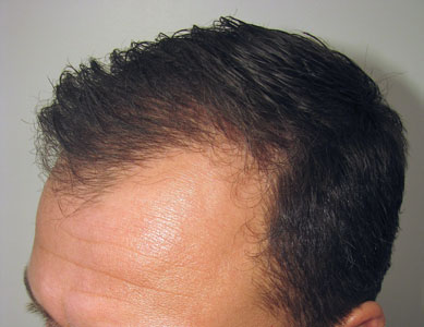 4b Man nine months after treatment-web(2433grafts)