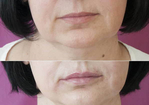 lips before-after-web