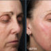 Nouvelle approche thérapeutique pour traiter le vieillissement du visage pendant la ménopause