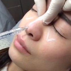 Le traitement du nez par les injections : une alternative à la chirurgie