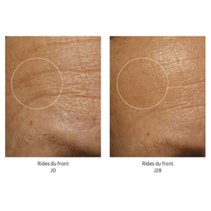 Softmesotherapy 